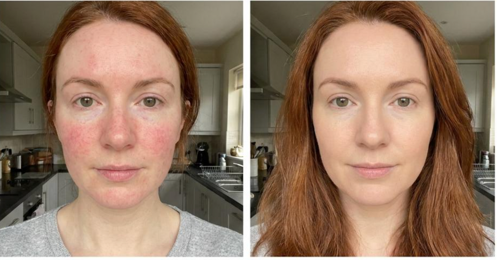 1. It Targets the Real Cause of Rosacea: Your Skin Barrier